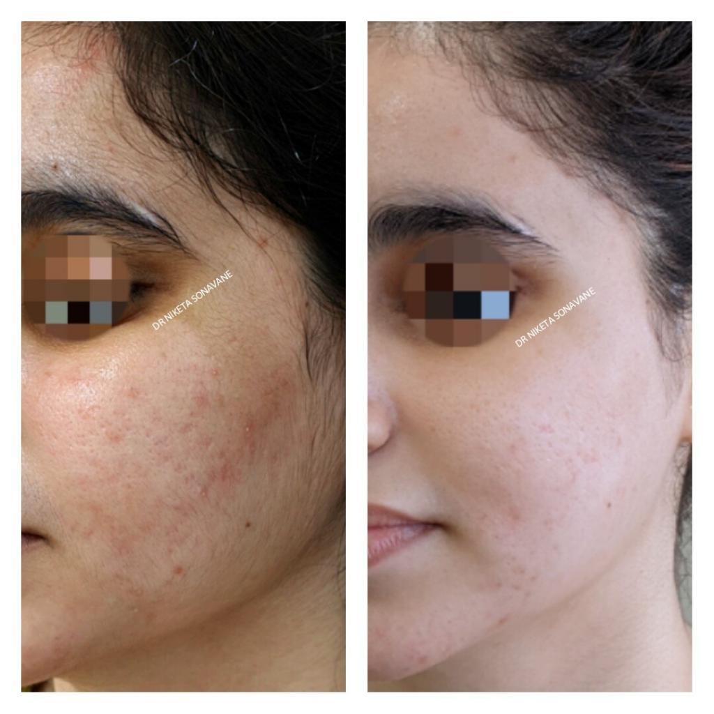 Acne removal treatment in Mumbai, pigmentation removal treatment, before and after results, skin lightening treatment in Mumbai
