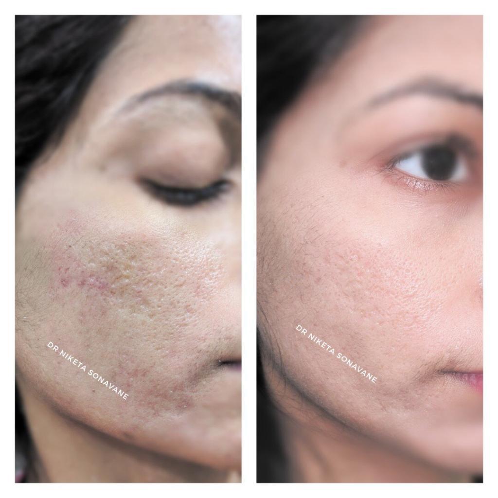 Acne scar treatment in Mumbai, PRP skin treatment in Mumbai, PRP skin treatment before after results