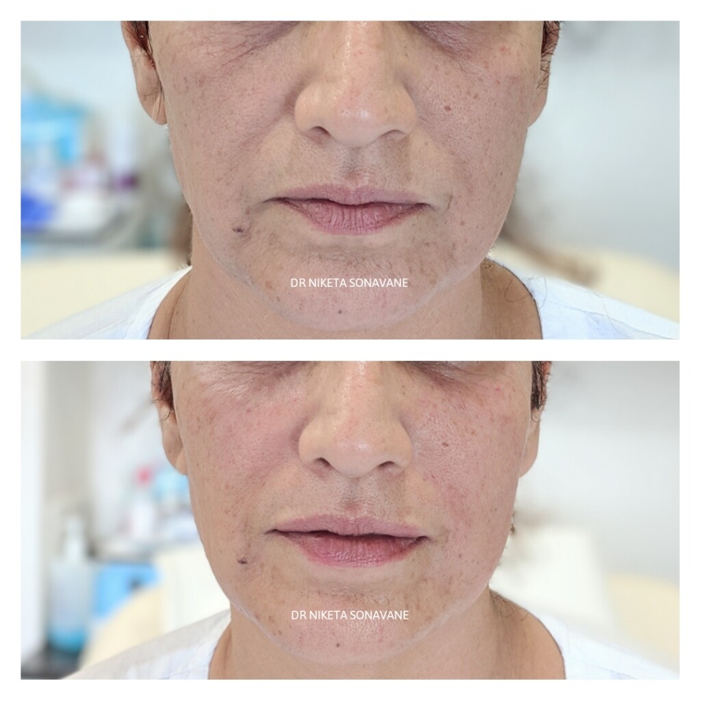 skin tightening treatment in Mumbai, best Dermatologist in Mumbai, skin tightening treatment before and after photos, cost of skin tightening treatment in mumbai, antiaging treatment in Mumbai, anti aging treatment before after, 