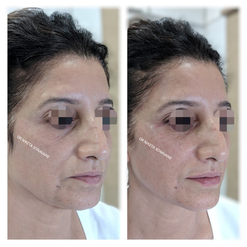dermal fillers in Mumbai, best Dermatologist in Mumbai, before and after photos