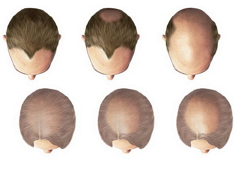 Hair Loss Treatment in Mumbai | Hairloss Treatment in ...