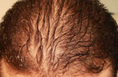 Hair loss Treatment in Mumbai