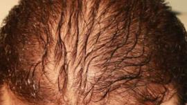 Diffuse Hair Loss Treatment in Mumbai - Cost, Procedure, Causes Diffuse Hair Loss Treatment in Mumbai - Cost, Procedure, Causes