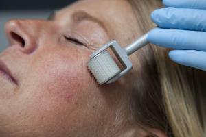 Dermaroller Treatment in Mumbai