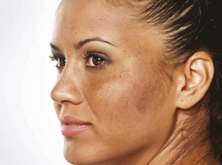 Pigmentation Treatment in Mumbai