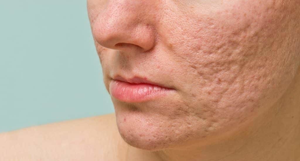 Acne Scars Treatment in Mumbai Dr Niketa Sonavane