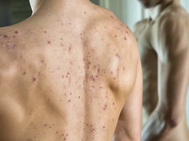 Back Acne Treatment in Mumbai - Cost, Before and After Results, Laser
