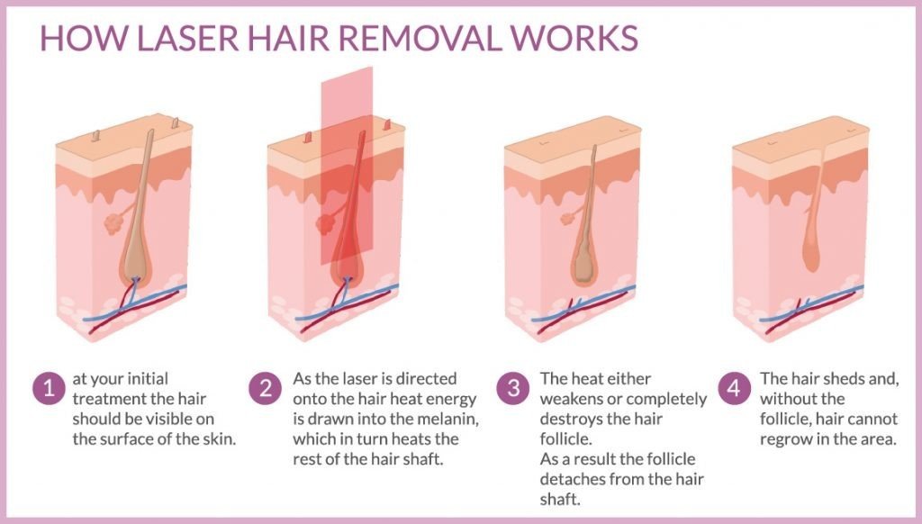 laser hair removal in mumbai - Dr Niketa Sonavane