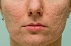 acne scars treatment in mumbai
