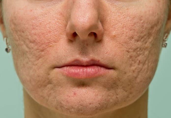 acne scars treatment in mumbai