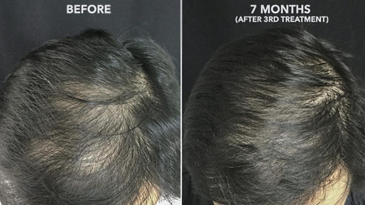 PRP Hair Treatment in Mumbai Platelet Rich Plasma, GFC Cost