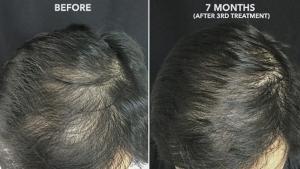 PRP hair treatment in Mumbai