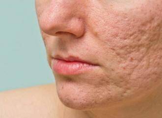 Acne scars treatment in Mumbai, best Dermatologist in Mumbai for acne scars