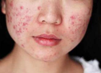 Acne treatment in Mumbai, best Dermatologist in Mumbai for acne