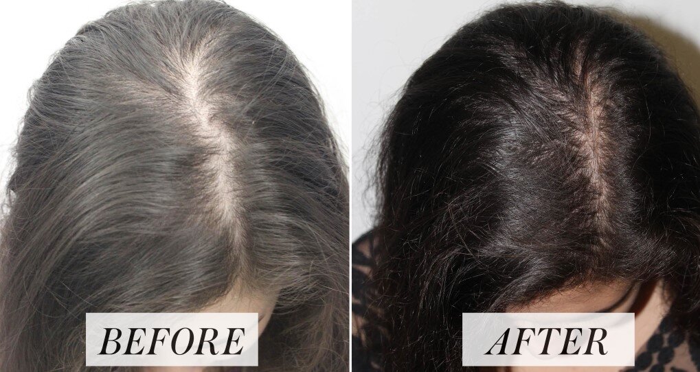 Hair Fall Treatment in Mumbai - Dr Niketa Sonavane