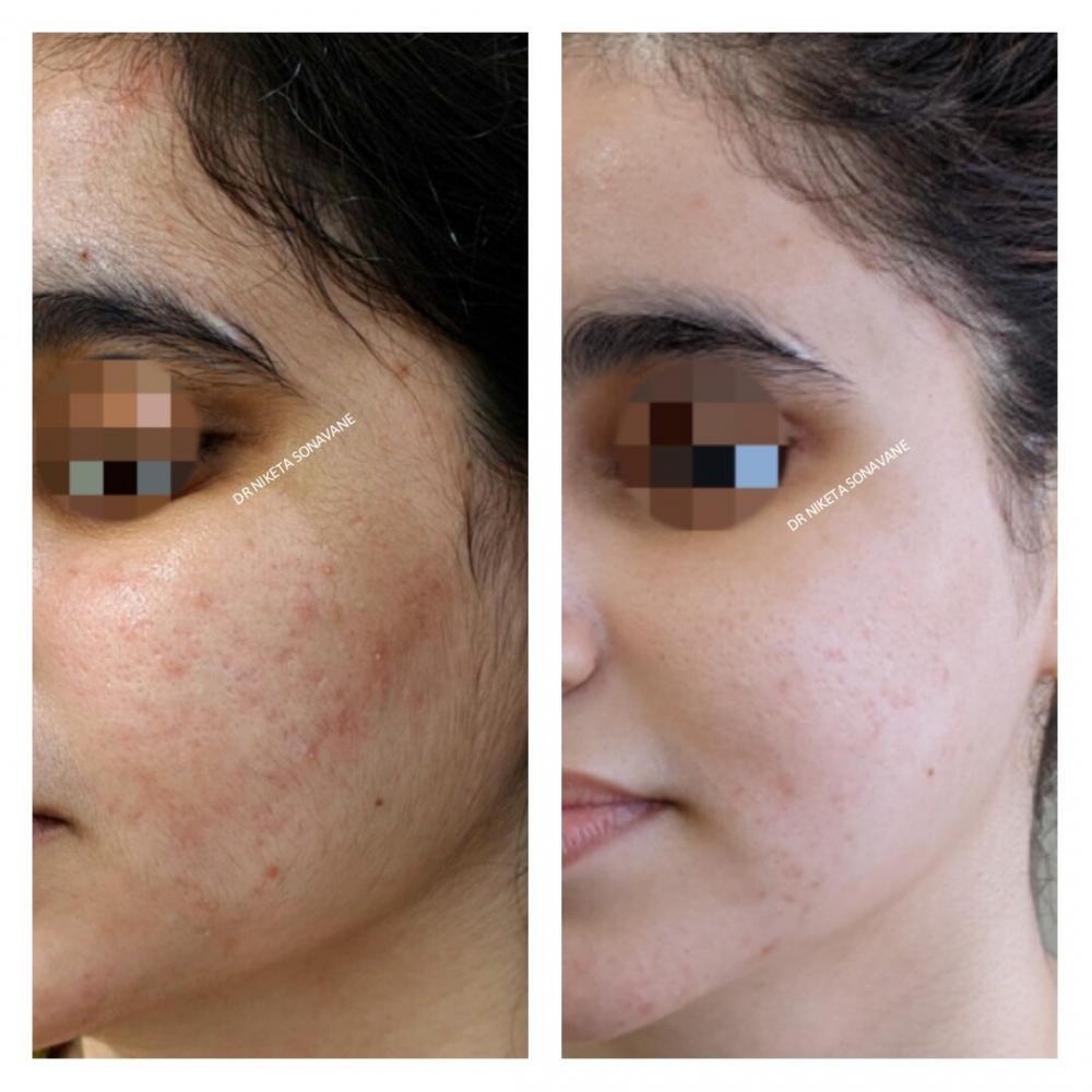 Acne Scar Treatment: From At-Home Care to Professional Procedures