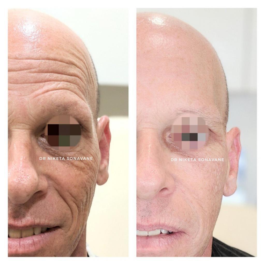 Botox, Botox, treatment, Botox injections, Botox in Mumbai, Botox treatment in Mumbai, Botox in men, Botox before after mumbai, Botox cost mumbai, dermal filler, dermal filler cheeks, dermal filler Mumbai, dermal filler before after, dermal filler cost mumbai, Juvederm XC mumbai, Juvederm XC cost mumbai, skin tightening treatment, skin tightening treatment mumbai, skin tightening treatment before after, skin tightening treatment cost mumbai, anti ageing treatment, anti ageing treatment mumbai, anti ageing treatment before after, anti ageing treatment cost mumbai, glutathione injections, gluta injection, L glutathione injection, glutathione injections cost, glutathione iv drip, glutathione injections side effects, gluta iv drip, glutathione iv treatment, glutathione injections mumbai, Dr. Niketa Sonavane, Ambrosia Aesthetics, top dermatologist mumbai, dermatologist andheri west, celebrity dermatologist mumbai, Bollywood dermatologist, best dermatologist near me,