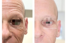 Botox in Mumbai, full face Botox treatment in Mumbai, before after, Anti aging treatment in Mumbai