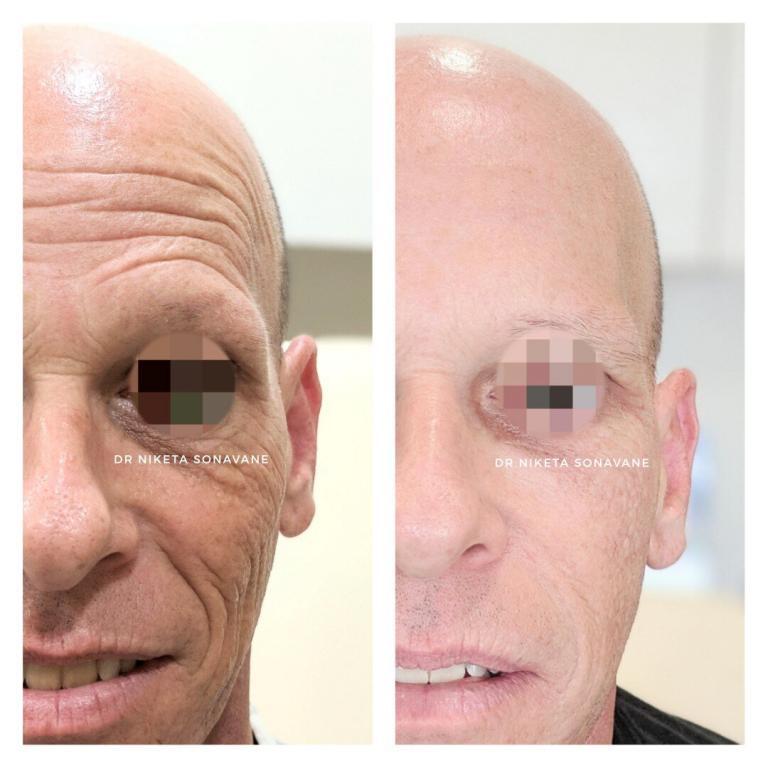 Botox, Botox, treatment, Botox injections, Botox in Mumbai, Botox treatment in Mumbai, Botox in men, Botox before after mumbai, Botox cost mumbai, dermal filler, dermal filler cheeks, dermal filler Mumbai, dermal filler before after, dermal filler cost mumbai, Juvederm XC mumbai, Juvederm XC cost mumbai, skin tightening treatment, skin tightening treatment mumbai, skin tightening treatment before after, skin tightening treatment cost mumbai, anti ageing treatment, anti ageing treatment mumbai, anti ageing treatment before after, anti ageing treatment cost mumbai, glutathione injections, gluta injection, L glutathione injection, glutathione injections cost, glutathione iv drip, glutathione injections side effects, gluta iv drip, glutathione iv treatment, glutathione injections mumbai, Dr. Niketa Sonavane, Ambrosia Aesthetics, top dermatologist mumbai, dermatologist andheri west, celebrity dermatologist mumbai, Bollywood dermatologist, best dermatologist near me,