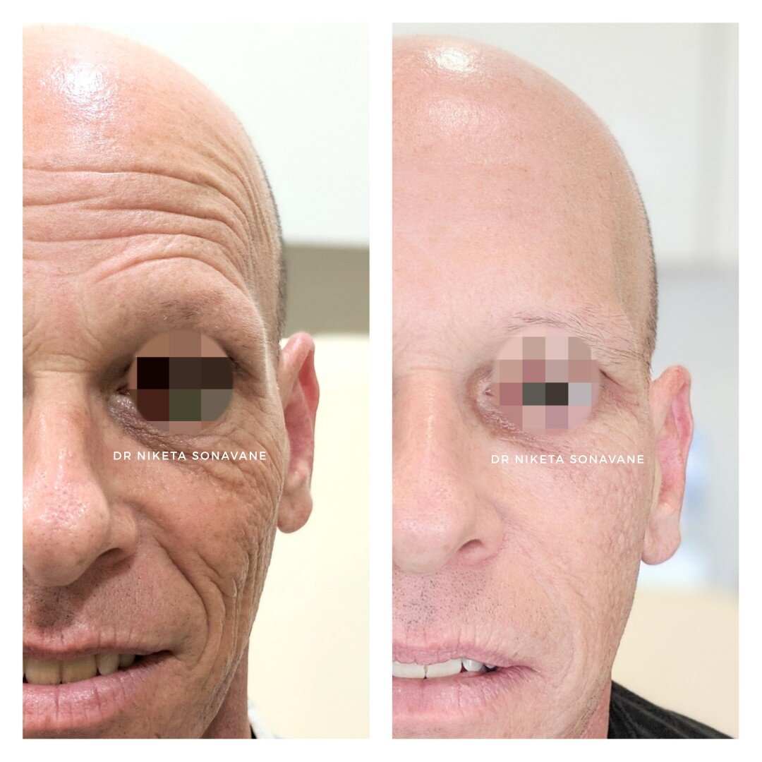 Botox in Mumbai, full face Botox treatment in Mumbai, before after, Anti aging treatment in Mumbai