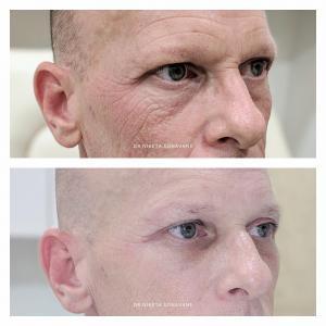 Botox in Mumbai, full face Botox treatment in Mumbai, before after