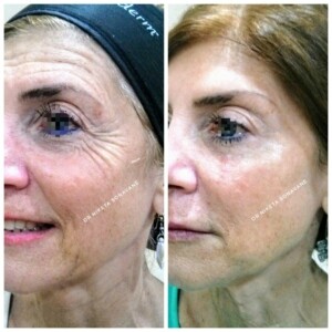 Botox in Mumbai, Botox treatment in Mumbai, full face botox treatment