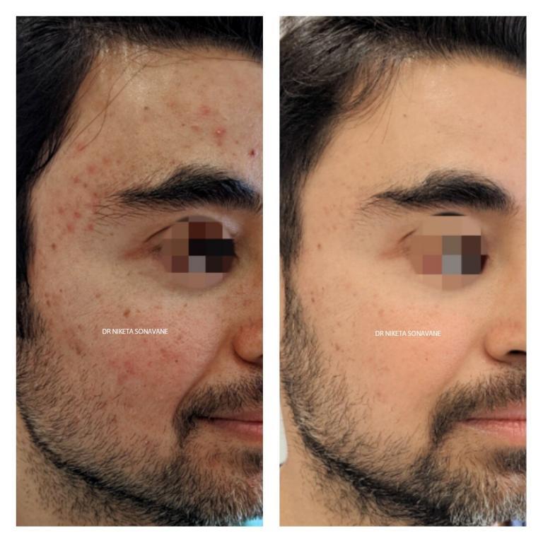 glutathione injections, gluta injection, L glutathione injection, glutathione injections cost, glutathione iv drip, glutathione injections side effects, gluta iv drip, glutathione iv treatment, glutathione injections mumbai, Acne treatment, acne treatment mumbai, acne treatment cost mumbai, acne treatment before after, best Dermatologist in Mumbai for acne, acne pimples removal before after, chemical peel for acne pimples, laser acne treatment, Pimples treatment, Pimple removal Mumbai, pimple treatment Mumbai, skin whitening treatment, skin whitening treatment Mumbai, body whitening treatment, skin whitening treatment before after, skin whitening treatment cost mumbai, Dr. Niketa Sonavane, Ambrosia Aesthetics, top dermatologist mumbai, dermatologist andheri west, celebrity dermatologist mumbai, Bollywood dermatologist, best dermatologist near me,