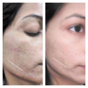PRP skin treatment in Mumbai, PRP skin treatment before after results