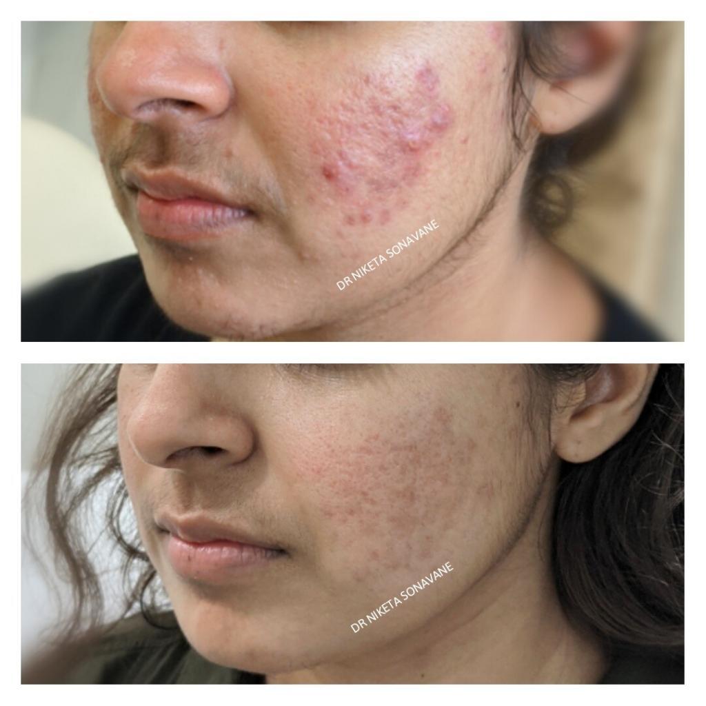Dermatologist in Mumbai, Skin Treatment Before and After Photos