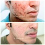 Acne Treatment In Mumbai Before and After Results, best dermatologist in Mumbai for acne treatment, acne scars treatment in Mumbai, best dermatologist in Mumbai for acne scars treatment
