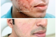 Acne Treatment In Mumbai Before and After Results, best dermatologist in Mumbai for acne treatment, acne scars treatment in Mumbai, best dermatologist in Mumbai for acne scars treatment