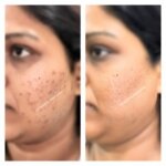 Pigmentation Treatment in Mumbai before and after results, microdermabrasion in Mumbai, skin Polishing treatment in Mumbai