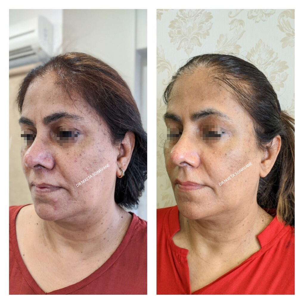 Skin Tightening Treatment In Mumbai Cost Before After Procedures