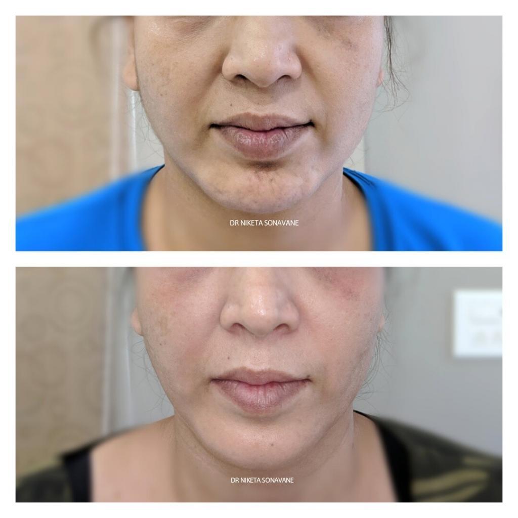 anti aging treatment in Mumbai, anti aging treatment before after, Botox Treatment in Mumbai, chin reshaping with Botox and dermal fillers in Mumbai