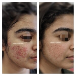 Acne treatment in Mumbai, best Dermatologist in Mumbai for acne