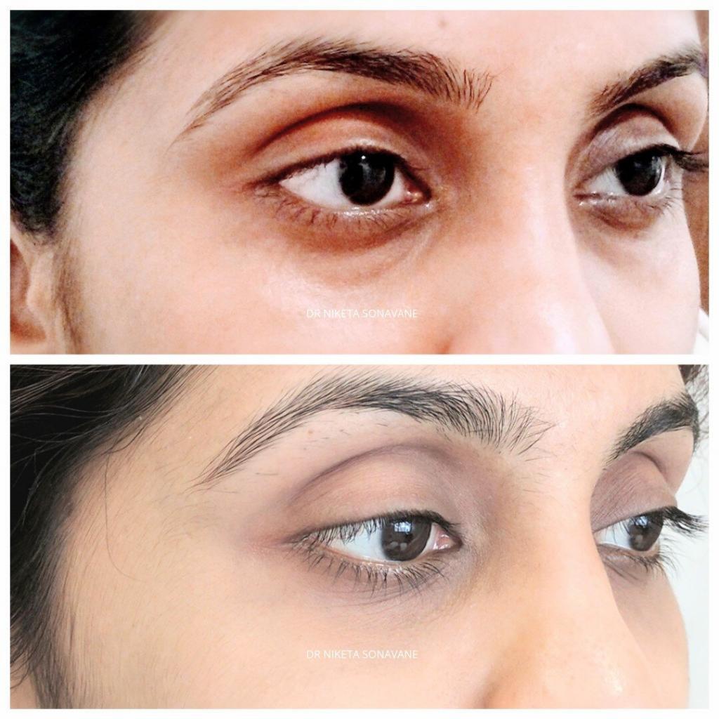 Dark Circles Treatment in Mumbai, under eye fillers in mumbai, dark circles removal in Mumbai