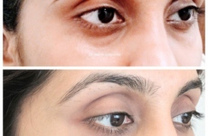 Dark Circles Treatment in Mumbai, under eye fillers in mumbai, dark circles removal in Mumbai