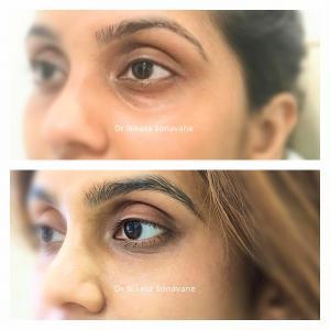 Dark Circles Treatment in Mumbai, under eye fillers in mumbai, dark circles removal in Mumbai