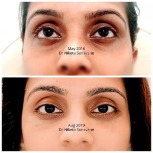 dark circles treatment in Mumbai, under eye fillers in Mumbai, dermal fillers in Mumbai, before after