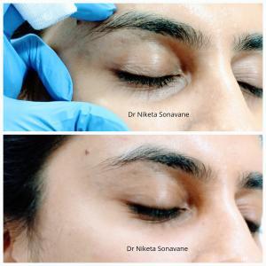 dark circles treatment in Mumbai, under eye fillers in Mumbai, dermal fillers in Mumbai, before after