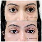 dark circles treatment in Mumbai, under eye fillers in Mumbai, dermal fillers in Mumbai, before after 4