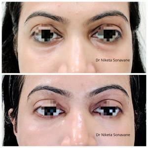 dark circles treatment in Mumbai, dark circles before after, under eye fillers for dark circles, dark circles treatment, dark circle removal