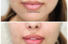 lip fillers in Mumbai, dermal fillers in Mumbai, Juvederm lip fillers before and after