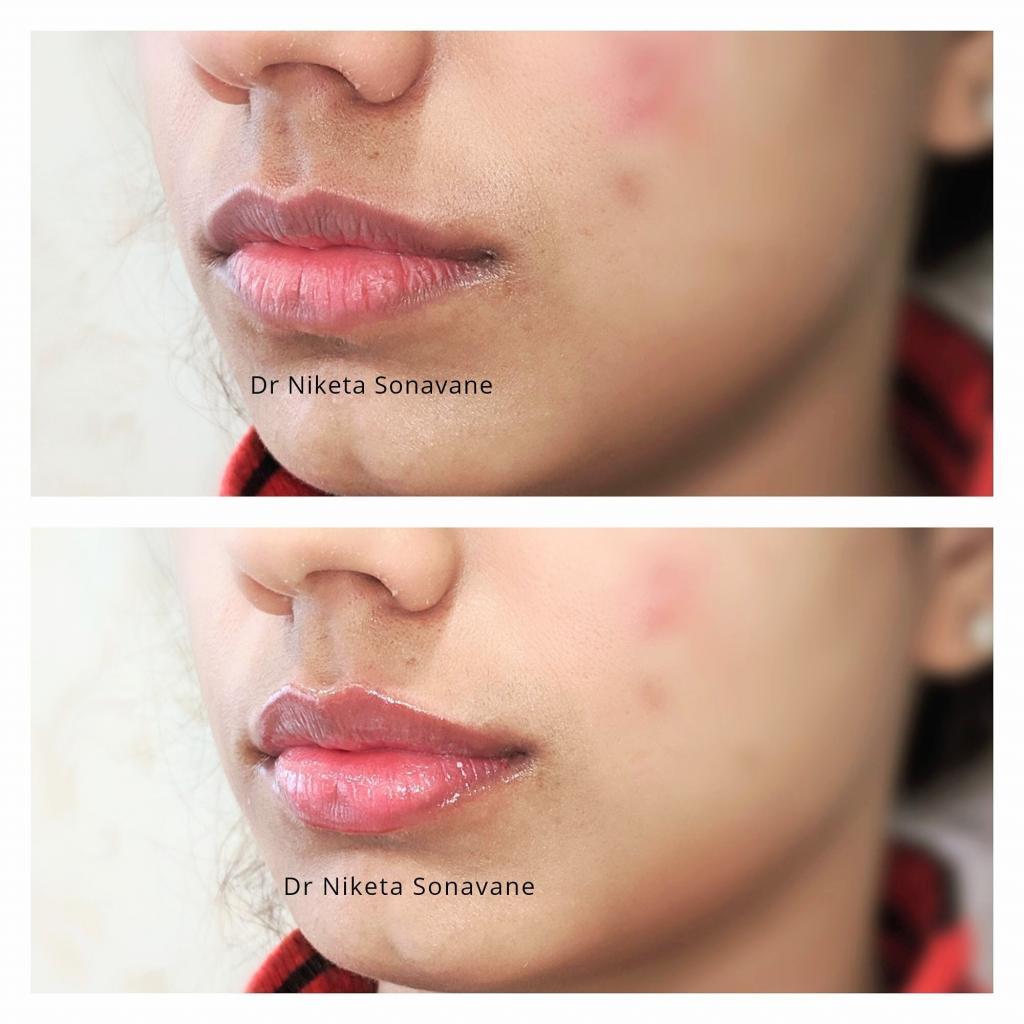 dermal filler, dermal filler Mumbai, dermal filler before after, dermal filler cost mumbai, Juvederm XC mumbai, Juvederm XC cost mumbai, lip filler, lip filler mumbai, lip filler before after, lip filler cost mumbai, Juvederm Volbella, Volbella XC cost Mumbai, lip lightening treatment, lip lightening treatment Mumbai, lip lightening treatment before after, lip lightening treatment cost mumbai, laser lip lightening mumbai, laser lip lightening cost, Dr. Niketa Sonavane, Ambrosia Aesthetics, top dermatologist mumbai, dermatologist andheri west, celebrity dermatologist mumbai, Bollywood dermatologist, best dermatologist near me,