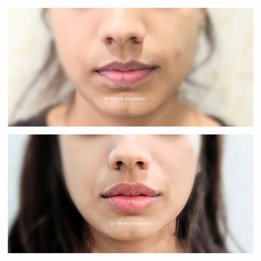 lip filler in Mumbai, dermal filler in Mumbai, Juvederm lip filler, Volbella lip filler, lip filler before after, lip enhancement, lip augmentation, lip injections, lip filler, dr niketa sonavane, best dermatologist in mumbai, 