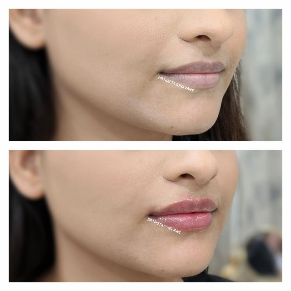 lip filler in Mumbai, dermal filler in Mumbai, Juvederm lip filler, Volbella lip filler, lip filler before after, lip enhancement, lip augmentation, lip injections, lip filler, dr niketa sonavane, best dermatologist in mumbai, 