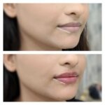 lip fillers in Mumbai, dermal fillers in Mumbai, before after results 10