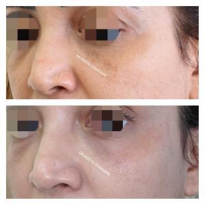 pigmentation treatment in Mumbai, skin lightening treatment in Mumbai, before and after results