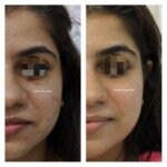 skin brightening treatment in Mumbai and Acne removal treatment, before and after results photo