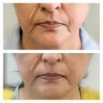 skin tightening treatment in Mumbai, HIFU facelift in Mumbai, before and after photo
